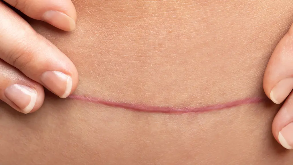 Why Is My C-Section Scar Painful, Itchy, and Sometimes Smelly? Understanding Postpartum Scar Care