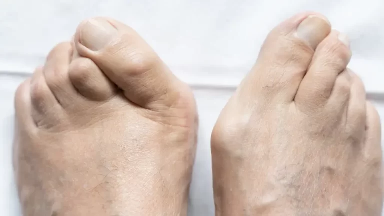 What Can You Do About a Hammertoe?