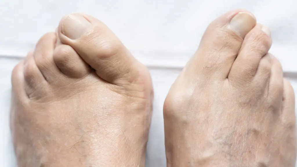 What Can You Do About a Hammertoe?